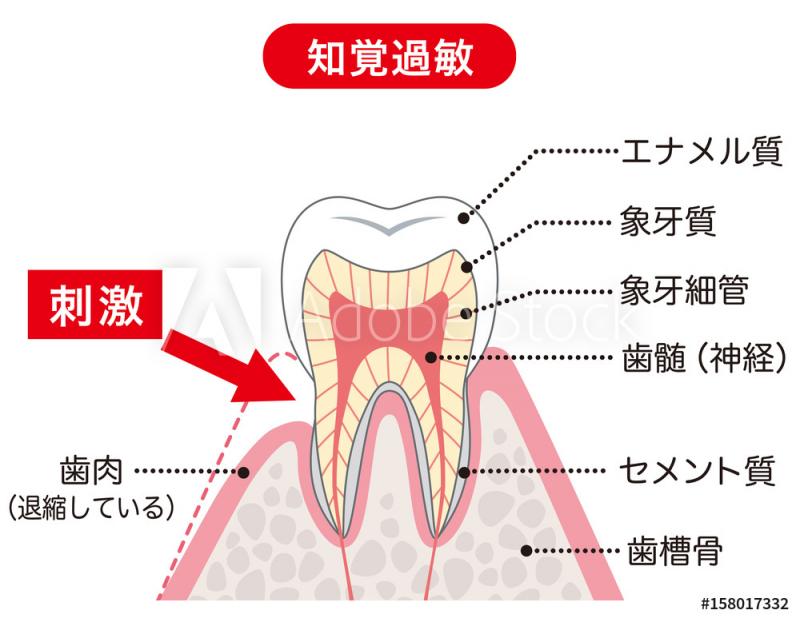 象牙質知覚過敏症