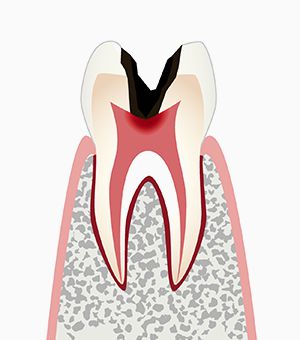 C3　歯髄まで虫歯菌が進入しています。