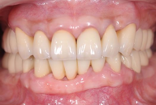 #CASE01 歯並びと歯周病で悩んでおられ来院された患者さま（50歳・女性）After