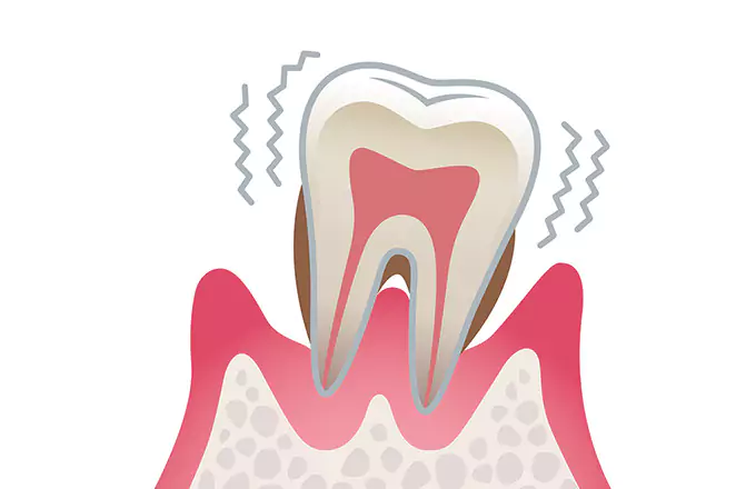 歯周病