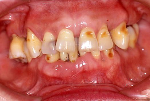 #CASE01 歯並びと歯周病で悩んでおられ来院された患者さま（50歳・女性）Before