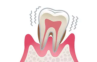 歯周病